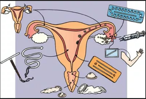 Contraception : résultats belges d’une étude internationale CHOICE