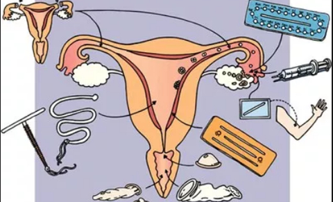Belgique : rembourser le stérilet et les patchs contraceptifs