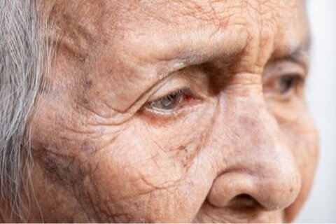 Vers l’euthanasie des personnes démentes sans leur consentement verbal ?