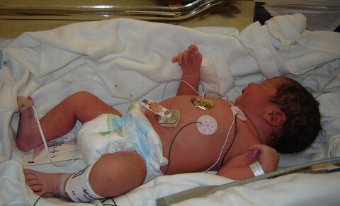 Artificial reproduction: study reveals increased risk of congenital heart defects in children